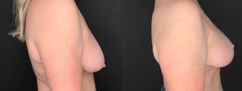 Patient #95623: Breast Lift with Liposuction Combine Image