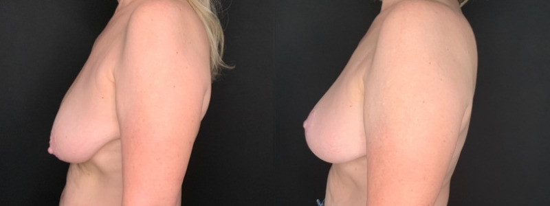 Patient #95623: Breast Lift with Liposuction Combine Image