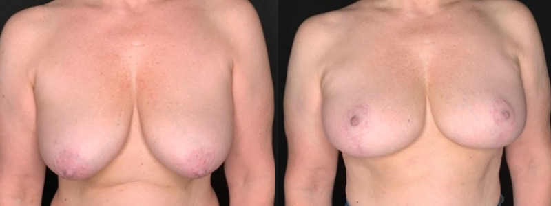 Patient #95623: Breast Lift with Liposuction Combine Image