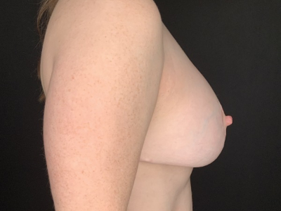 Patient #78596: Breast Lift with Implants After Image