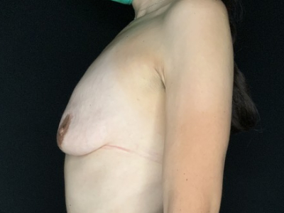 Patient #67891: Breast Lift with Implants Before Image