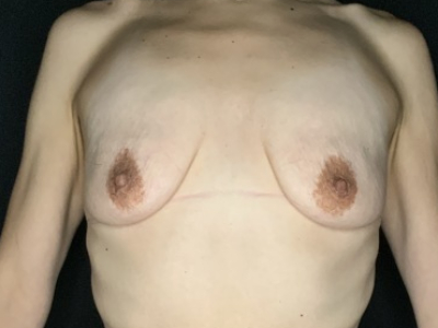 Patient #67891: Breast Lift with Implants Before Image