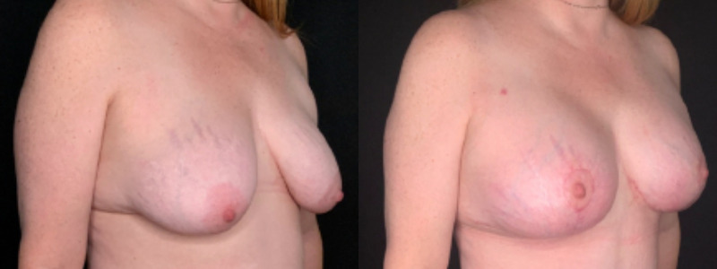Patient #59874: Breast Lift with Implants Combine Image