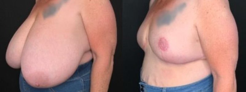Patient #62584: Breast Reduction with Free Nipple Graft Combine Image