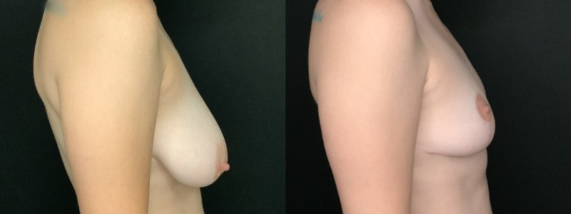 Patient #49657: Breast Reduction Combine Image