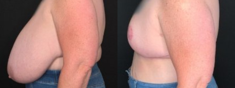 Patient #62584: Breast Reduction with Free Nipple Graft Combine Image