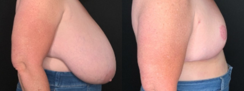 Patient #62584: Breast Reduction with Free Nipple Graft Combine Image