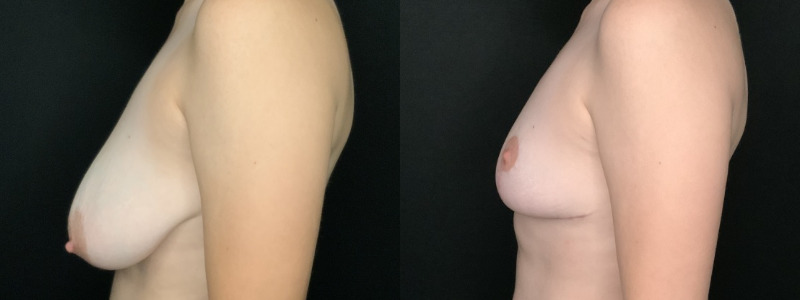 Patient #49657: Breast Reduction Combine Image