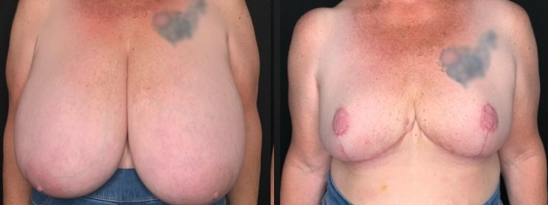 Patient #62584: Breast Reduction with Free Nipple Graft Combine Image