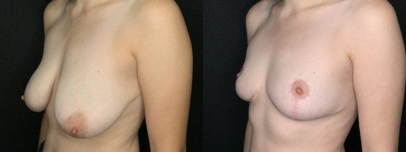 Patient #49657: Breast Reduction Combine Image