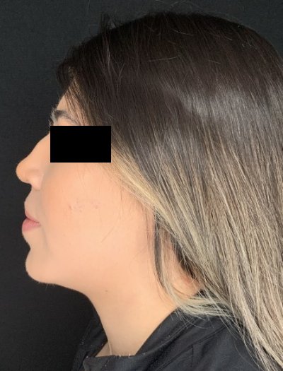 Patient #69857: Chin Augmentation After Image