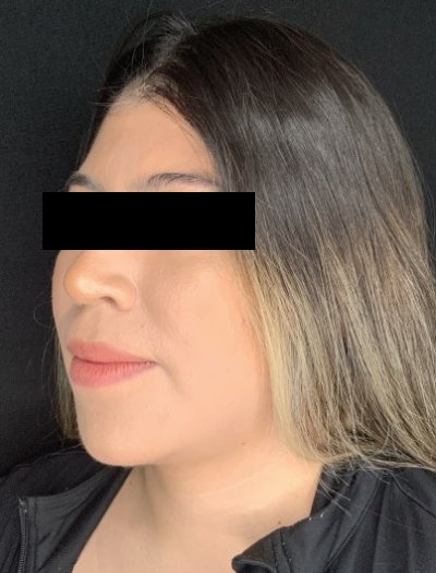 Patient #69857: Chin Augmentation After Image