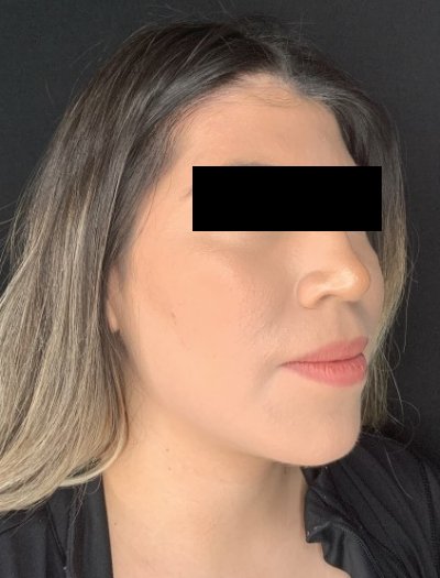 Patient #69857: Chin Augmentation After Image