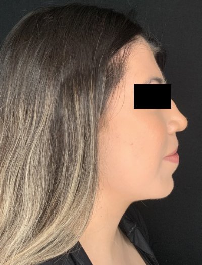 Patient #69857: Chin Augmentation After Image