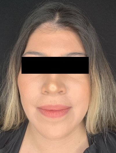 Patient #69857: Chin Augmentation After Image