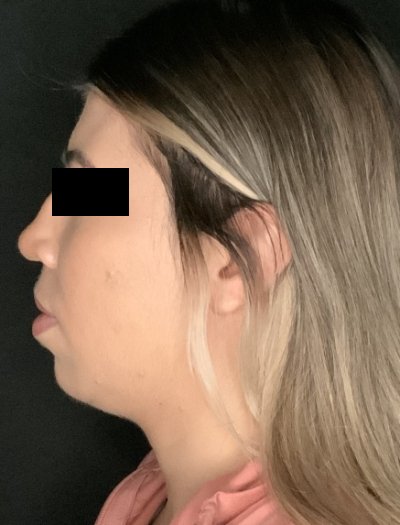 Patient #69857: Chin Augmentation Before Image