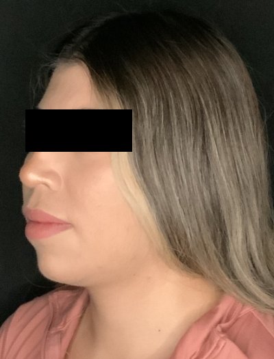 Patient #69857: Chin Augmentation Before Image