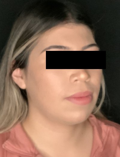 Patient #69857: Chin Augmentation Before Image