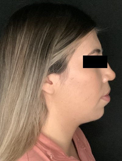 Patient #69857: Chin Augmentation Before Image