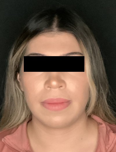 Patient #69857: Chin Augmentation Before Image