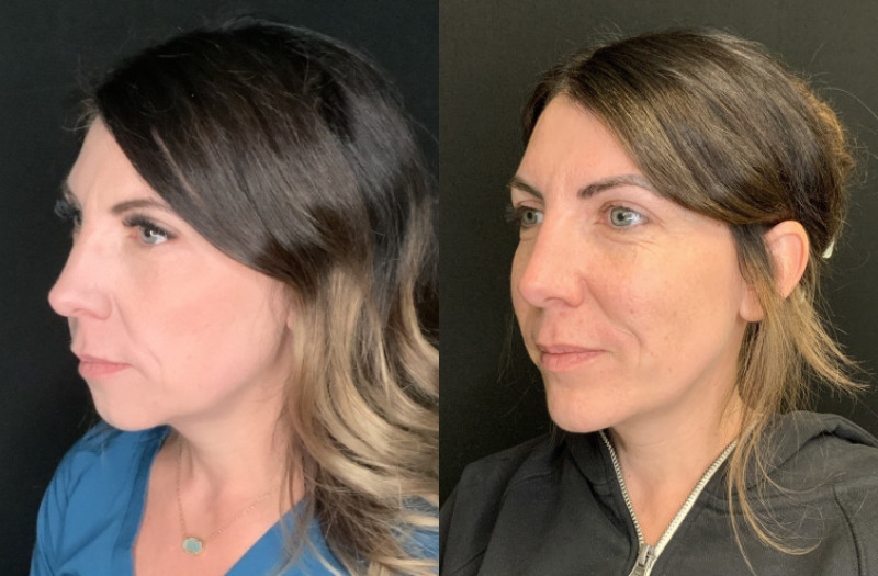 Patient #23754: Chin Augmentation Combine Image