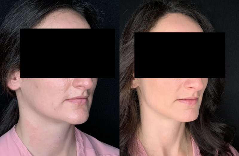 Patient #14569: Chin Reduction Combine Image