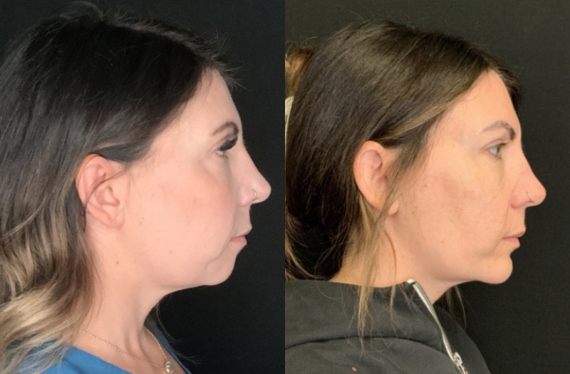 Patient #23754: Chin Augmentation Combine Image