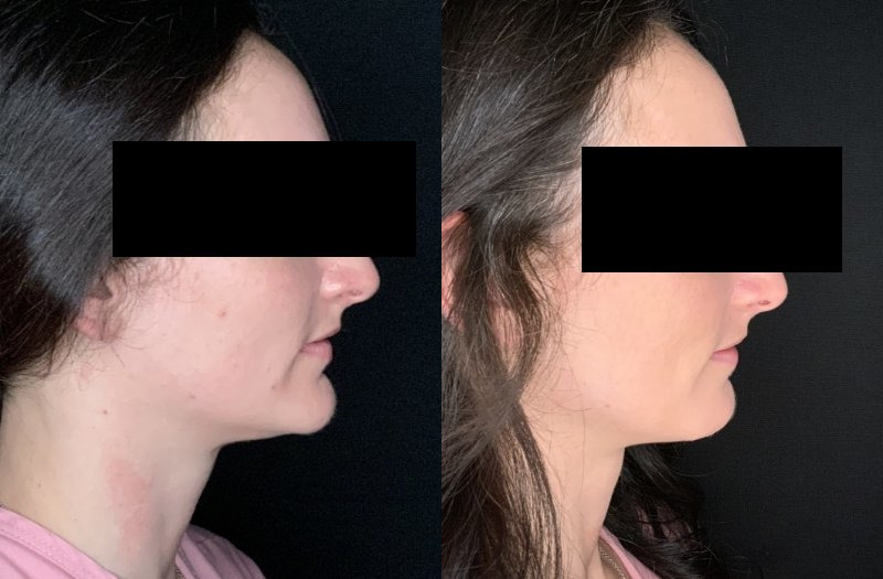 Patient #14569: Chin Reduction Combine Image