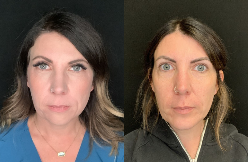 Patient #23754: Chin Augmentation Combine Image
