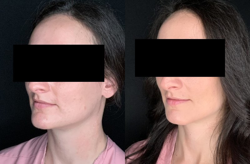 Patient #14569: Chin Reduction Combine Image