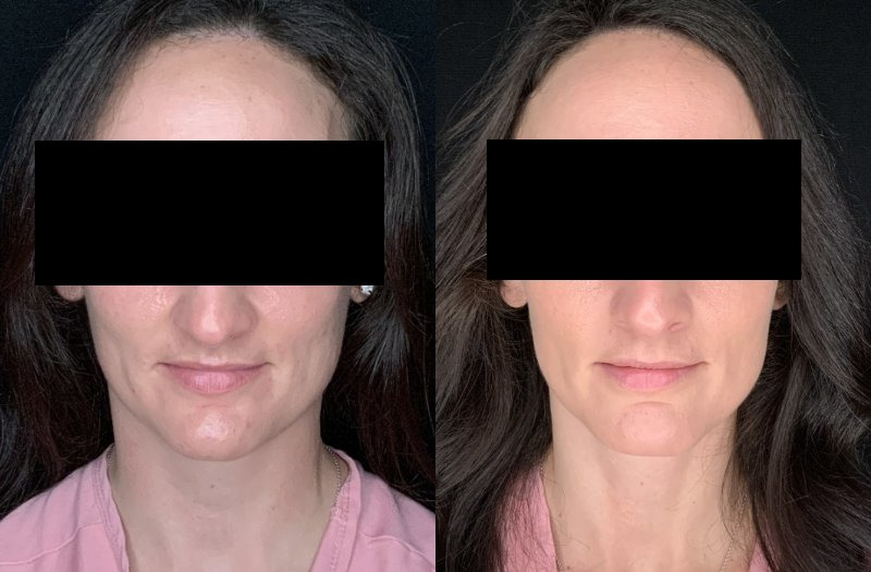 Patient #14569: Chin Reduction Combine Image