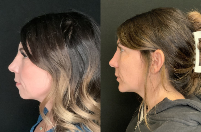 Patient #23754: Chin Augmentation Combine Image