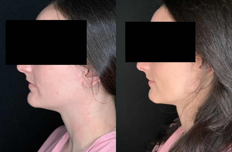Patient #14569: Chin Reduction Combine Image