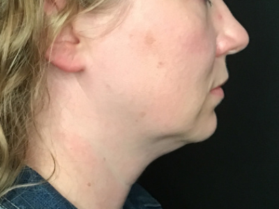 Patient #22256-02: CoolSculpting & Kybella After Image