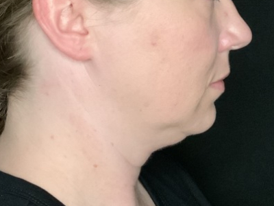 Patient #22256-02: CoolSculpting & Kybella Before Image