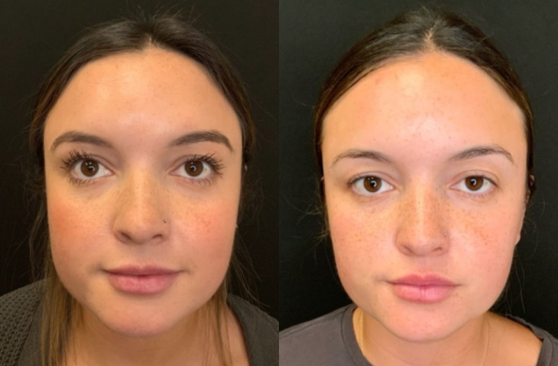 Patient #54896: Lip Flip Combine Image
