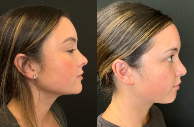 Patient #54896: Lip Flip Combine Image