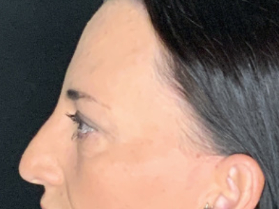 Paciente n.° 37854: Imagen posterior a la blefaroplastia
