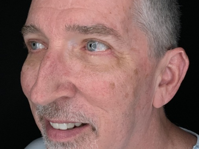 Patient #63258: Upper Blepharoplasty with Facial Fat Injections After Image