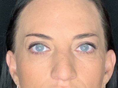 Paciente n.° 37854: Imagen posterior a la blefaroplastia