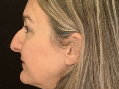 Patient #85874: Upper Blepharoplasty with Browpexy and Facial Fat Injections After Image