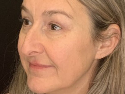 Patient #85874: Upper Blepharoplasty with Browpexy and Facial Fat Injections After Image