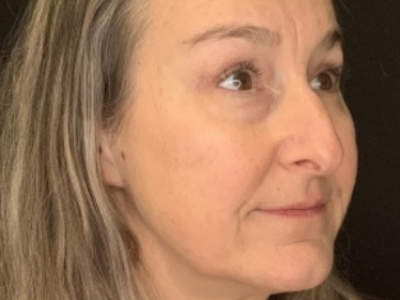 Patient #85874: Upper Blepharoplasty with Browpexy and Facial Fat Injections After Image
