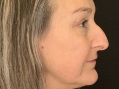 Patient #85874: Upper Blepharoplasty with Browpexy and Facial Fat Injections After Image