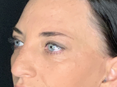 Paciente n.° 37854: Imagen posterior a la blefaroplastia