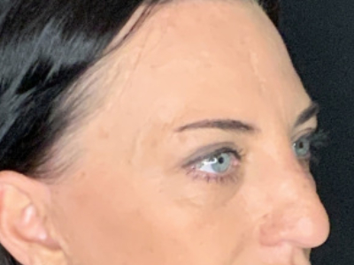 Paciente n.° 37854: Imagen posterior a la blefaroplastia