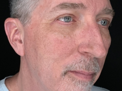 Patient #63258: Upper Blepharoplasty with Facial Fat Injections After Image