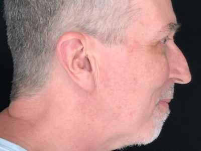 Patient #63258: Upper Blepharoplasty with Facial Fat Injections After Image