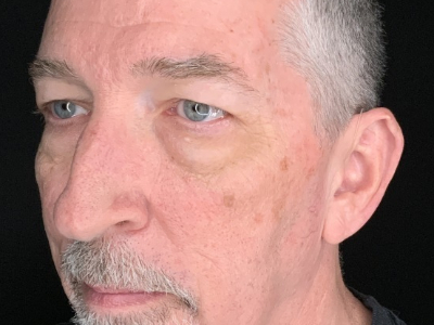 Patient #63258: Upper Blepharoplasty with Facial Fat Injections Before Image