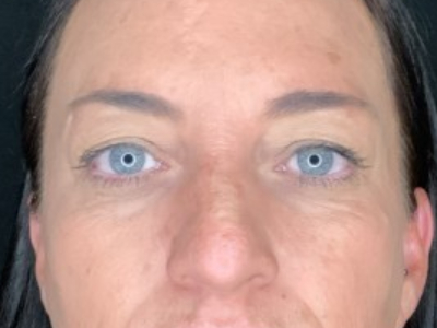 Paciente n.° 37854: Imagen previa a la blefaroplastia